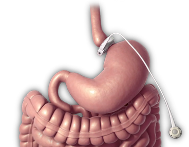 c9ffa362-lapband-stomach_0ab0820a807z000000001 c9ffa362-lapband-stomach_0ab0820a807z000000001